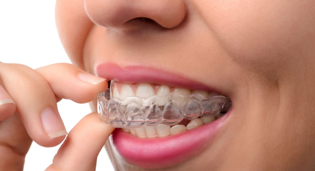 How Clear Aligners Work